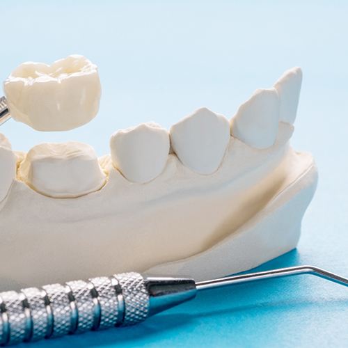 Dental crown fitting over a regular tooth in a mouth mold