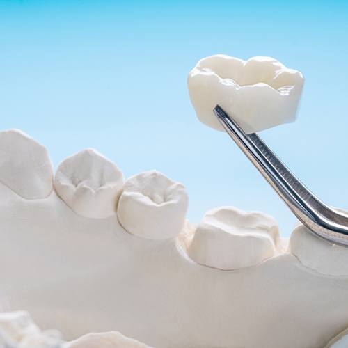 A dental crown