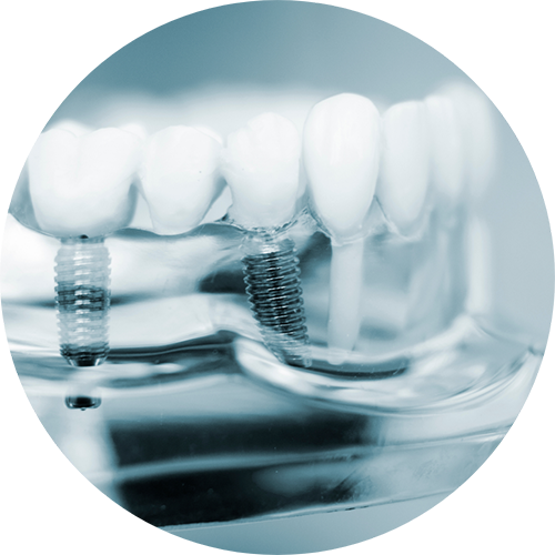 Model of the mouth with two dental implants