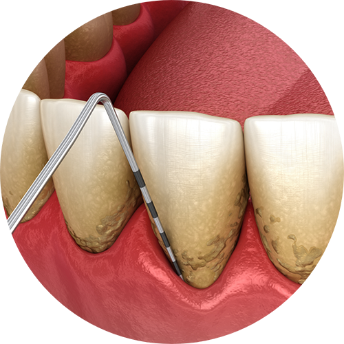 Illustration of a dental instrument measuring gum pockets
