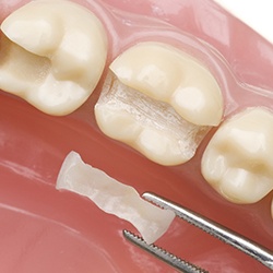 Model smile with inlay restoration