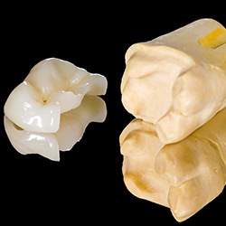 Model tooth with onlay restoration