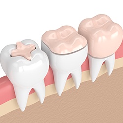 Animation of three teeth with filling, onlay, and crown