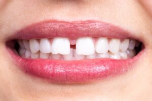 Close-up of smile showing gap between front teeth.